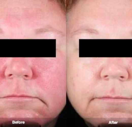 Everything you need to know about rosacea