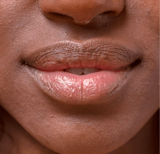 Salvation for dry, chapped lips