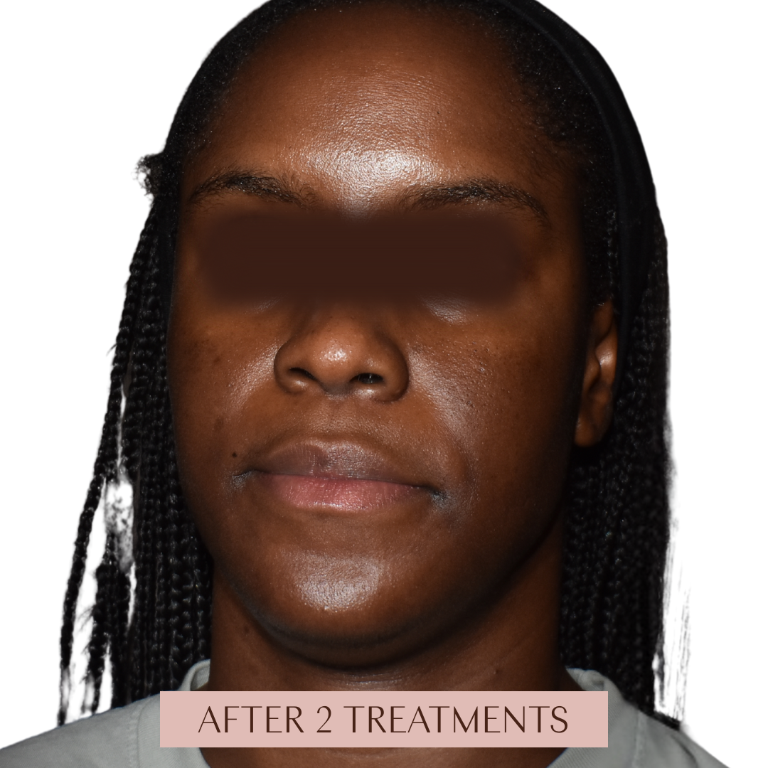 Radiant Renewal Plan (3 Month Plan)