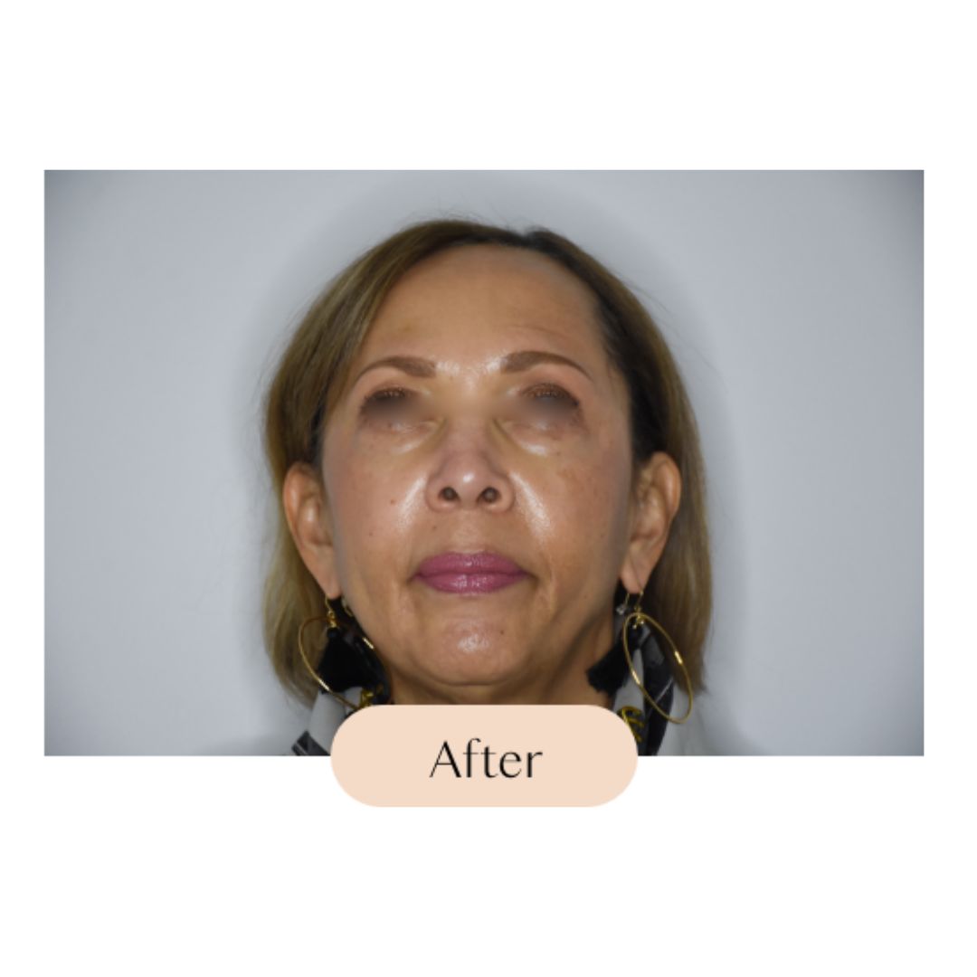 BOTOX®, Dysport® and Jeuveau®