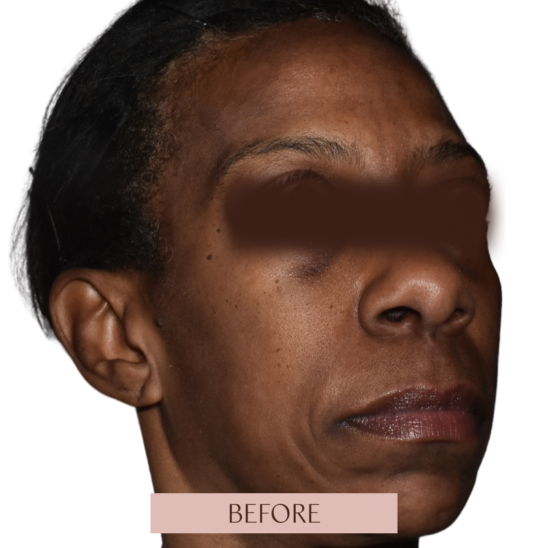 Balance - Tier 2 (Filler + Toxin)