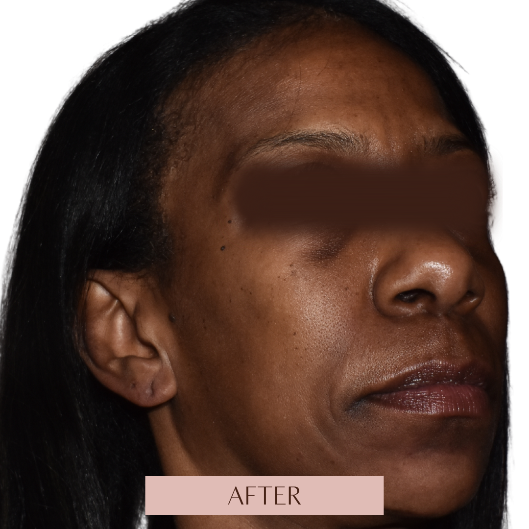 Balance - Tier 2 (Filler + Toxin)