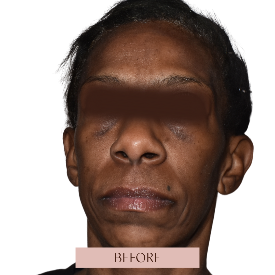 Balance - Tier 3 (Filler + Fotona 4D Laser)