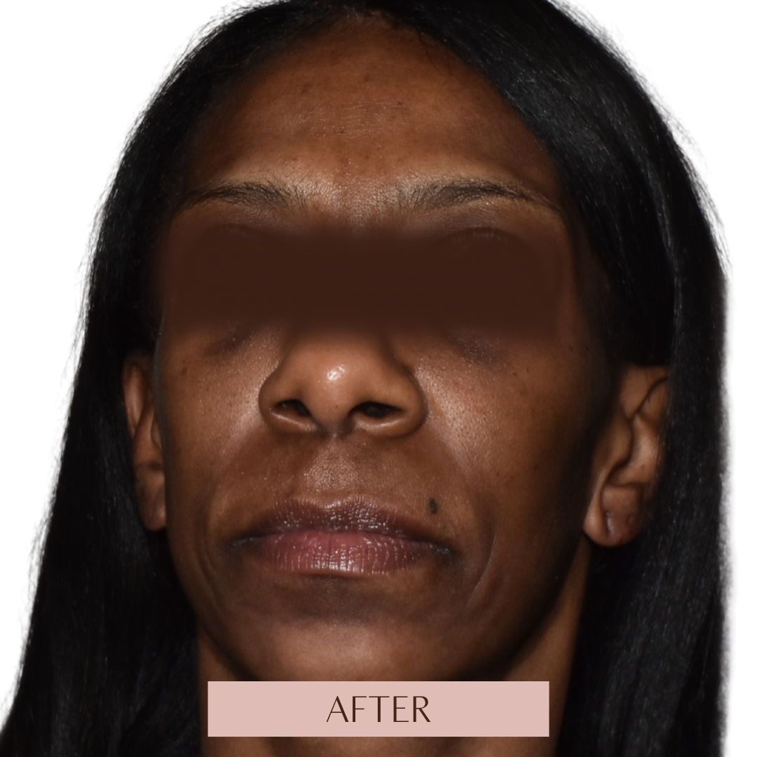 Balance - Tier 3 (Filler + Fotona 4D Laser)