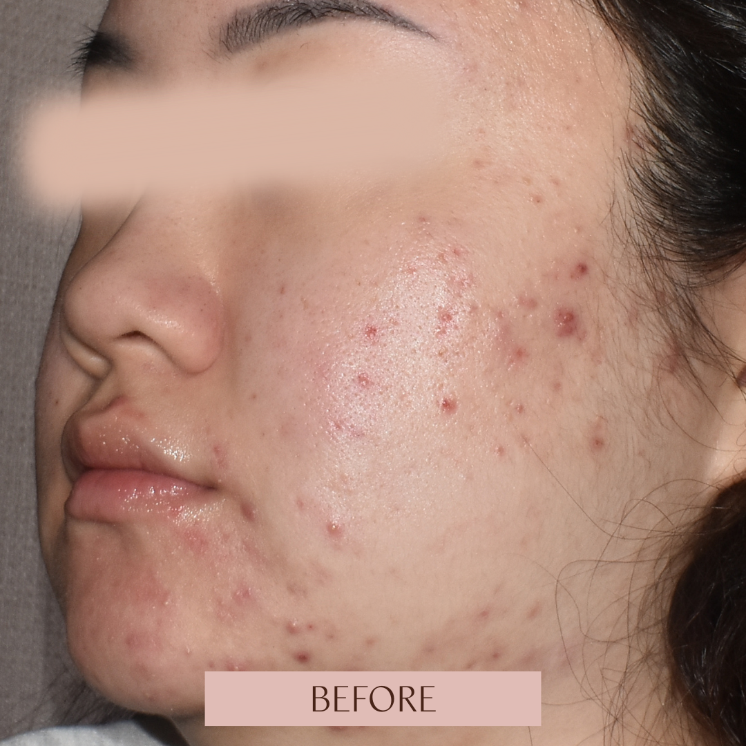 Clear Skin Reset
