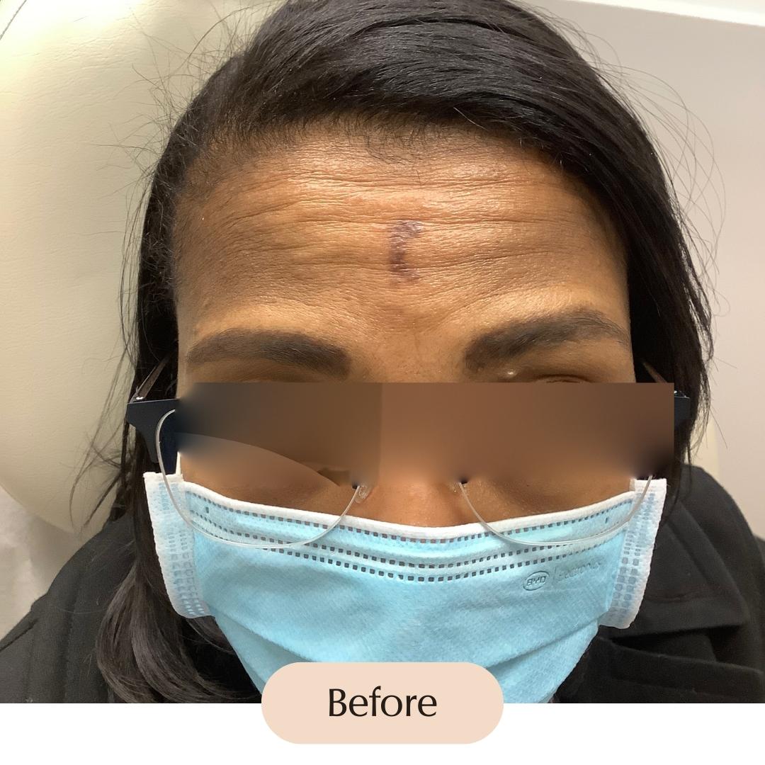 Scar Treatment bergenderm