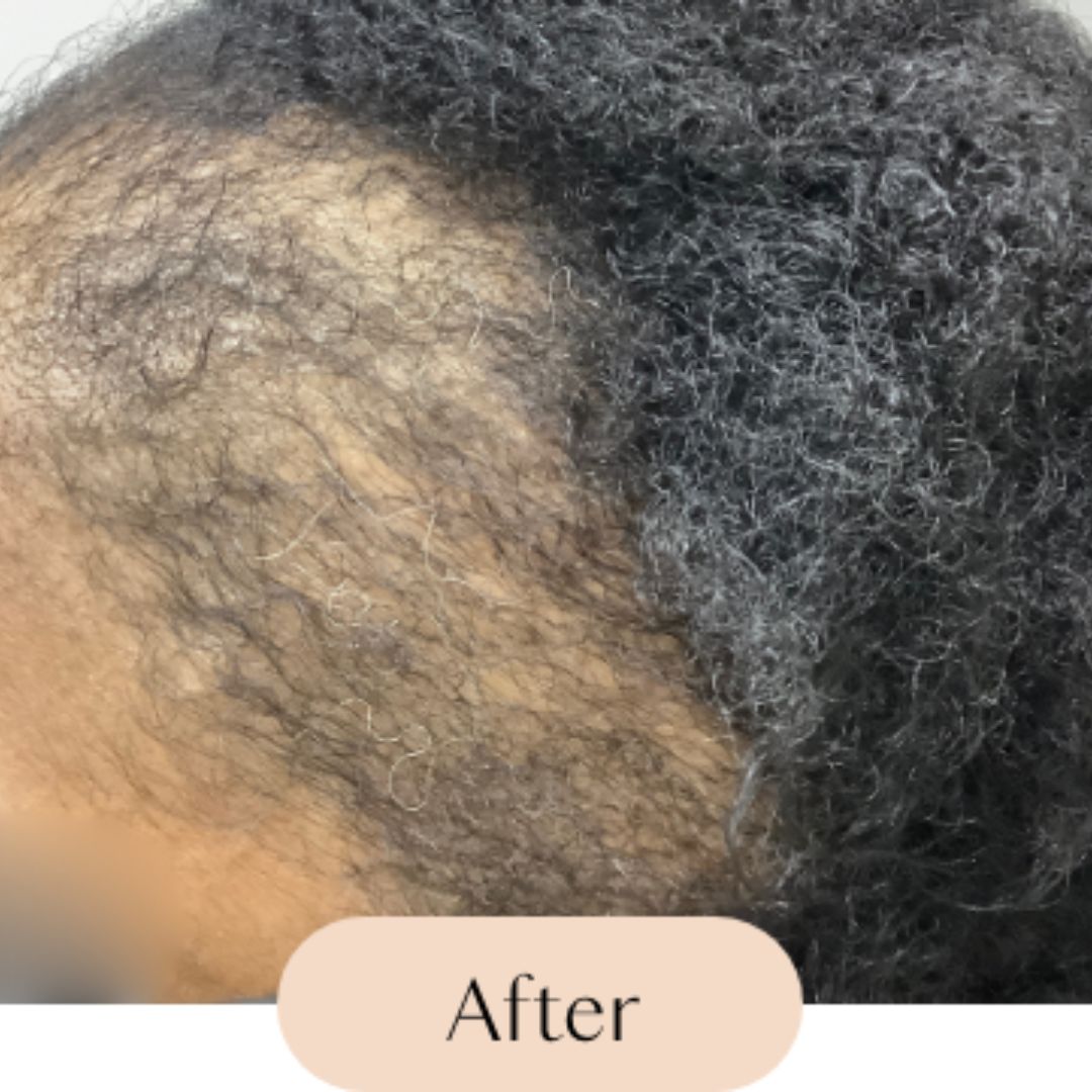 Alopecia (Hair Loss)