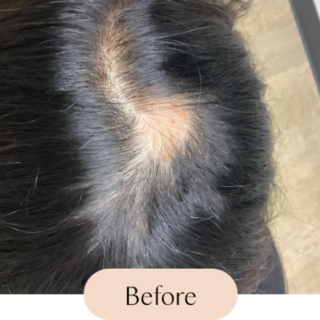 Alopecia (Hair Loss)