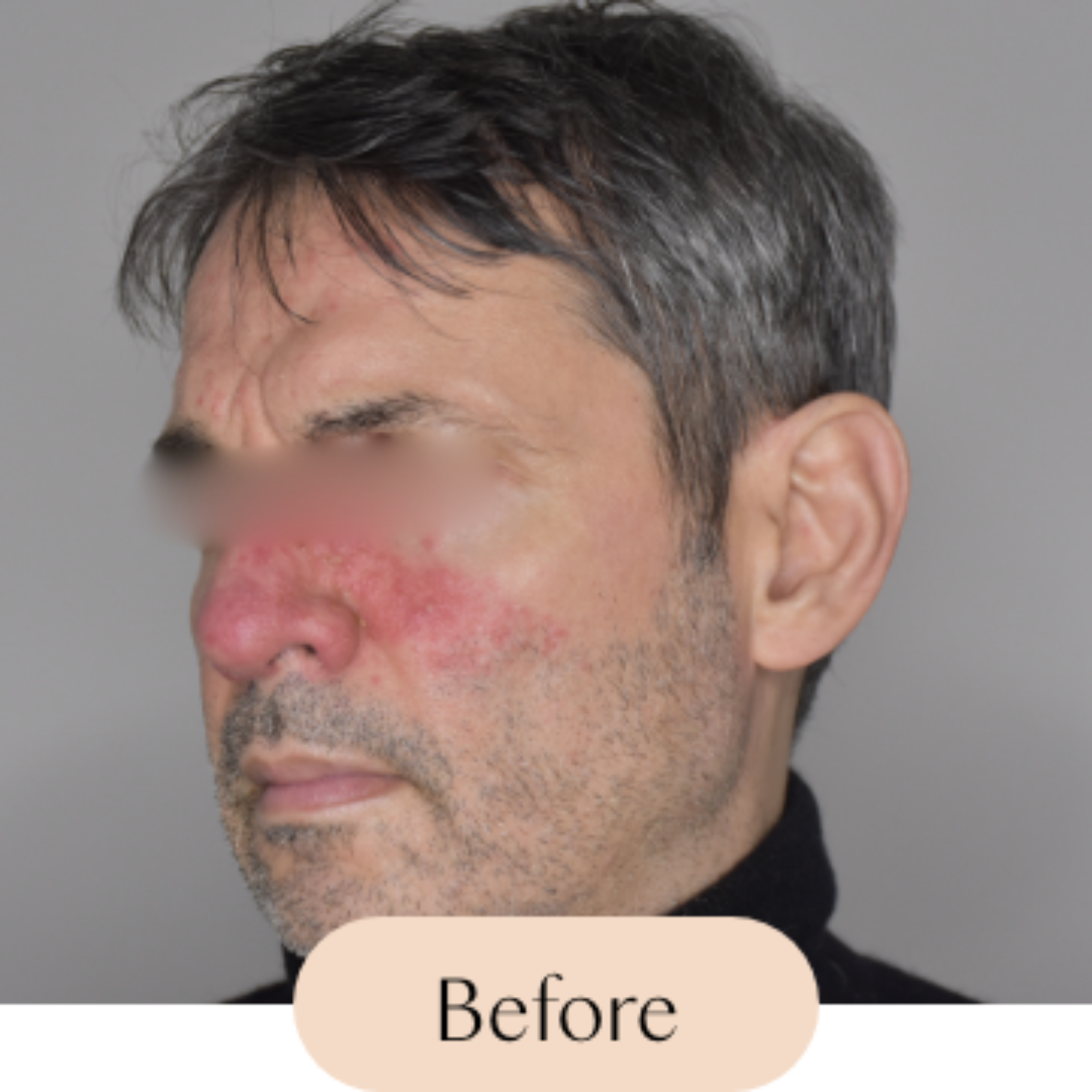 Rosacea