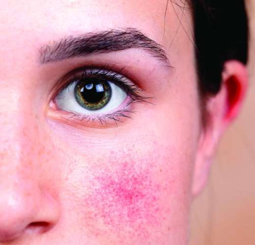 How to Practice the Anti-Rosacea Lifestyle
