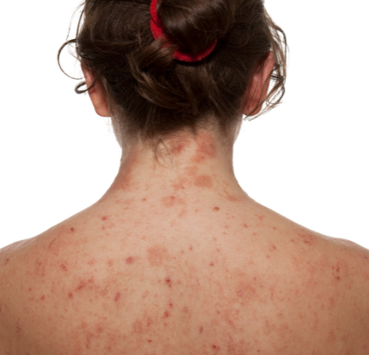 Your Guide for Managing Eczema