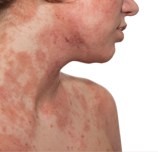 What’s the Real Deal with Eczema?