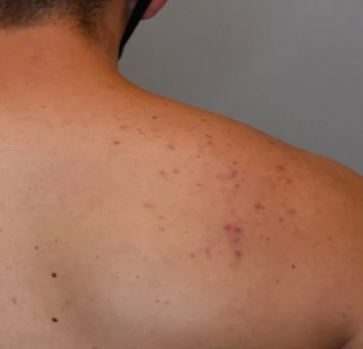 Body Rash Break Out How to handle body breakouts | bergenderm
