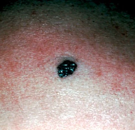 Are you at risk for melanoma?