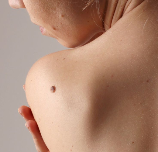 February Is About Skin Cancer Prevention