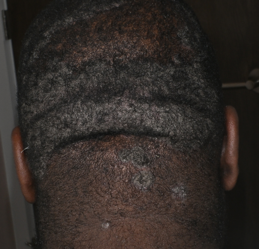 It Starts at the Cellular Level: Rethinking Psoriasis and Hair Loss This August