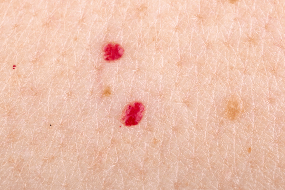 what-are-those-little-red-bumps-bergenderm