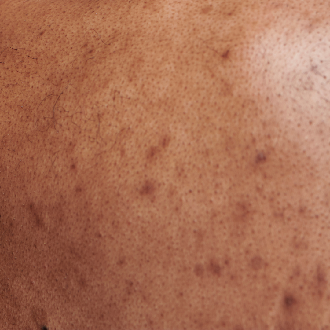 Pigmentation