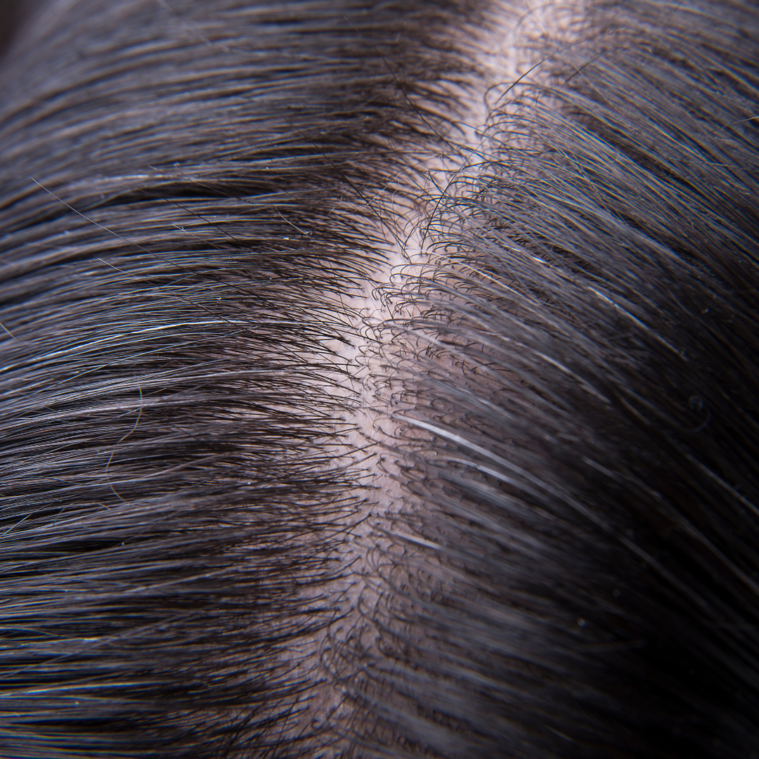 Hair Loss