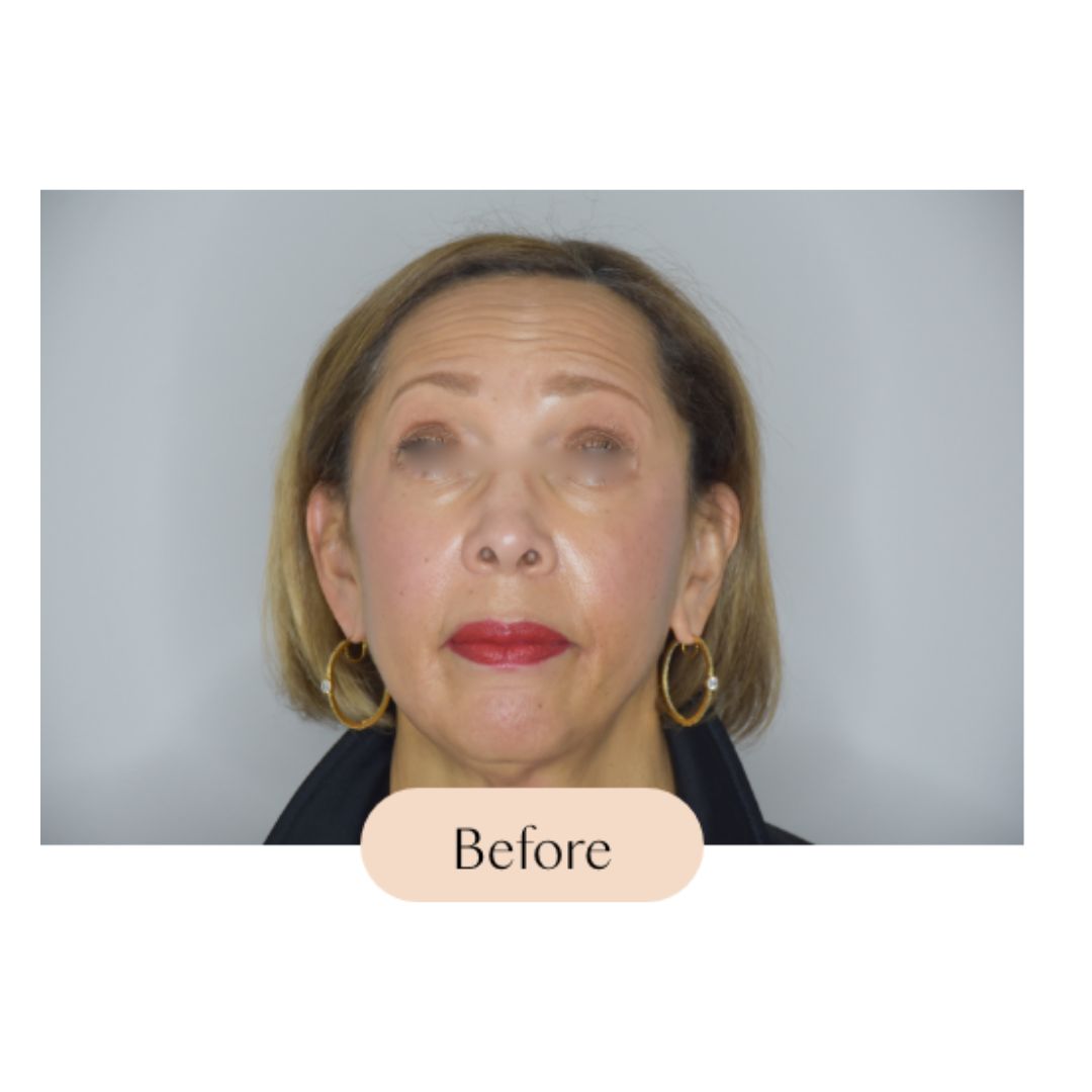 BOTOX®, Dysport® and Jeuveau®