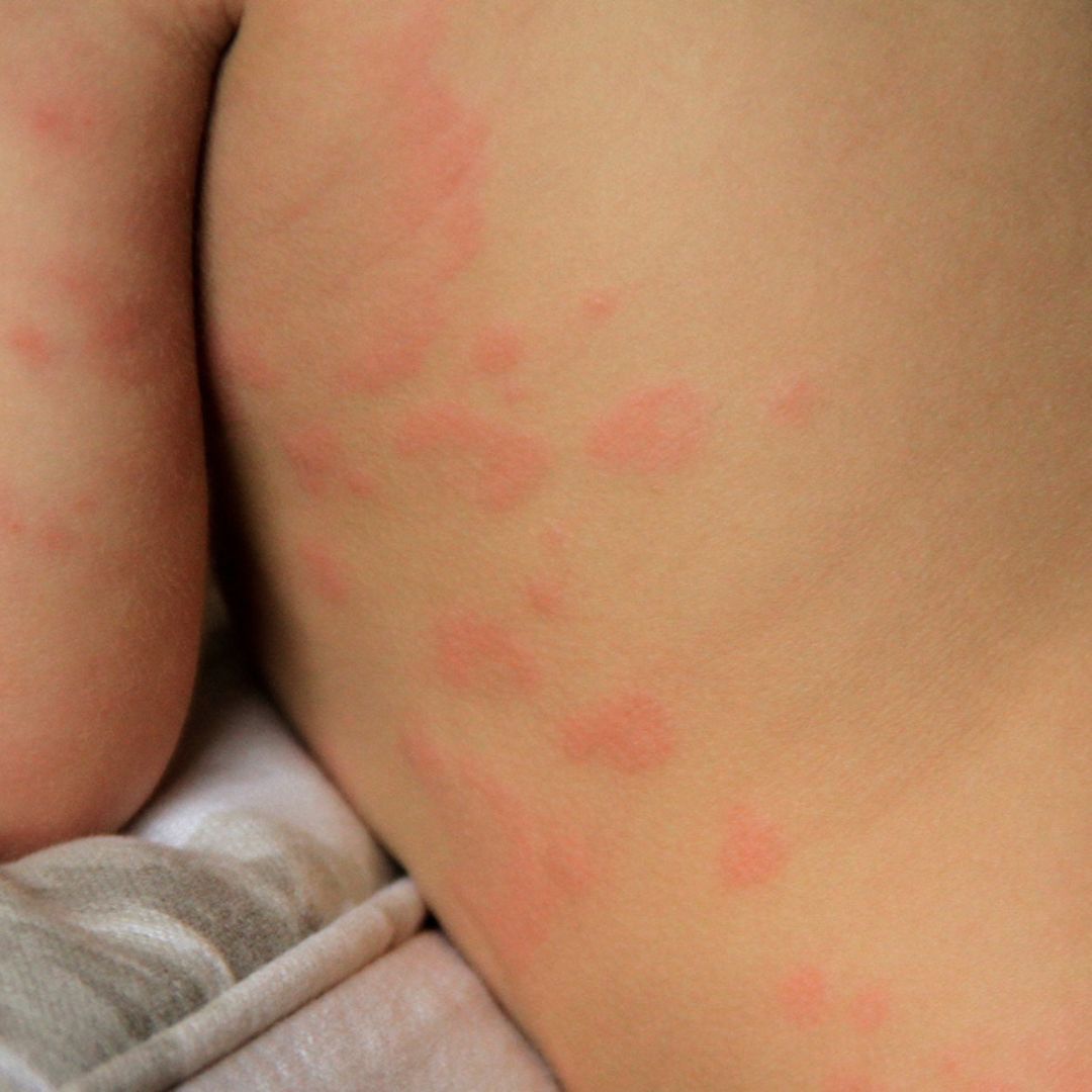 Allergic Rash On The Leg Of A Small Child Stock Photo By, 54% OFF