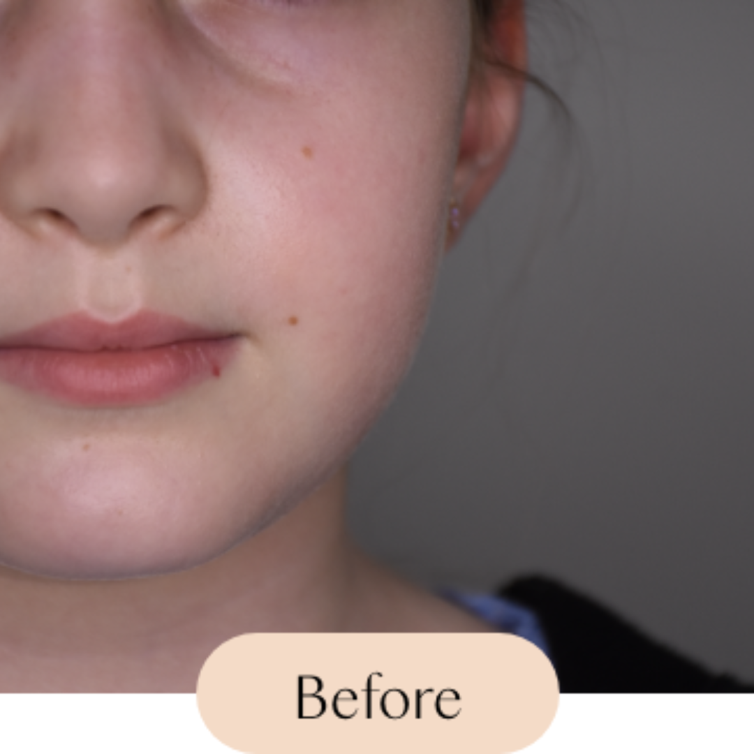 Cherry angioma (red lesion) on the lip was treated with a laser in one treatment.