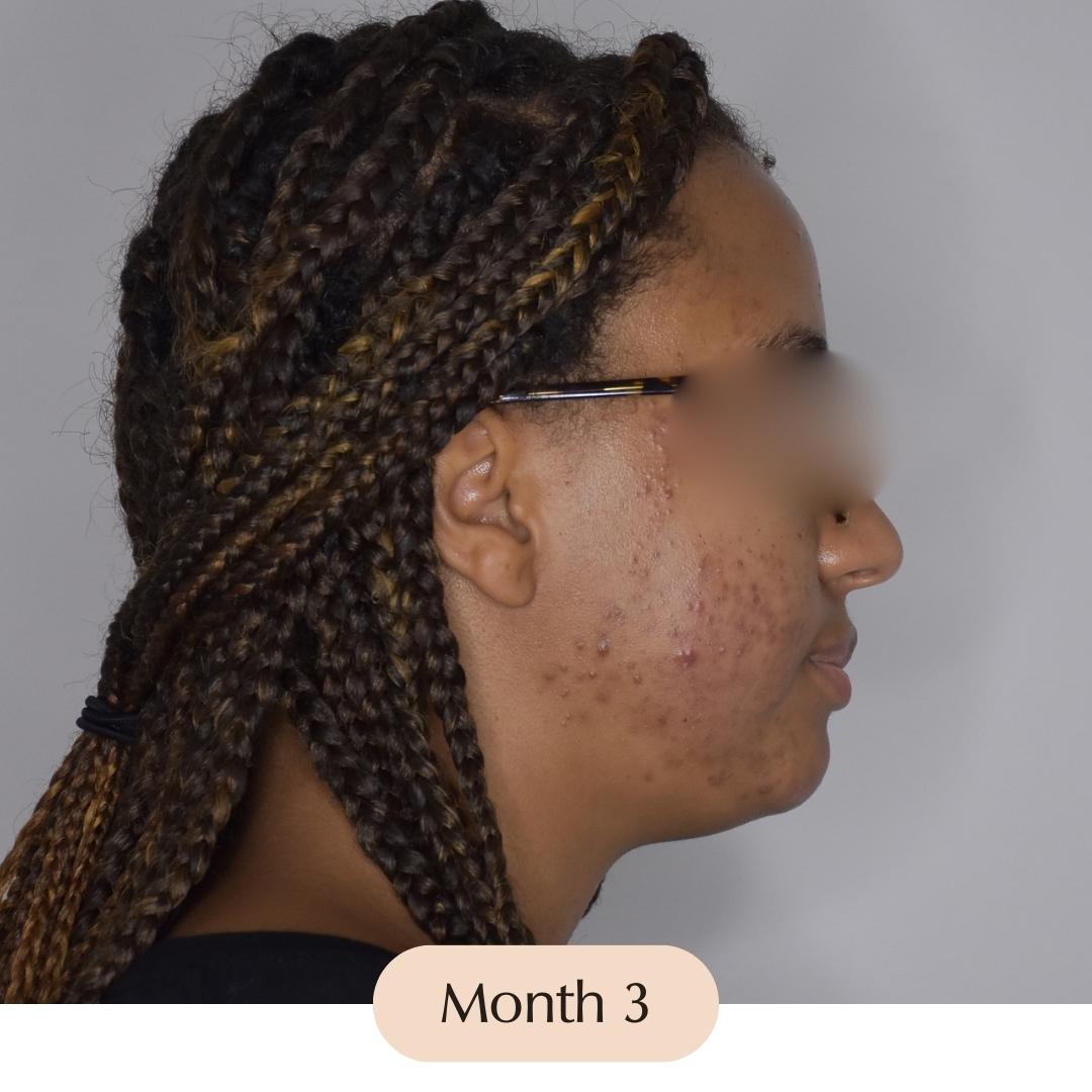 The Ultimate Acne Treatment Program